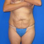 Avelar Tummy Tuck Before & After Patient #558