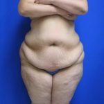 Liposuction Before & After Patient #596