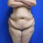 Liposuction Before & After Patient #596