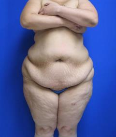 Liposuction Before & After Patient #596