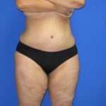 Liposuction Before & After Patient #596