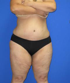 Liposuction Before & After Patient #596