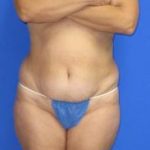 Liposuction Before & After Patient #580