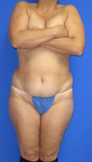 Liposuction Before & After Patient #580