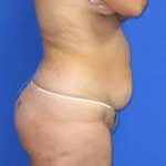 Liposuction Before & After Patient #580
