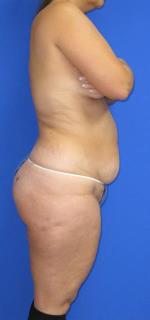 Liposuction Before & After Patient #580