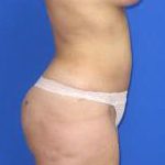 Liposuction Before & After Patient #580