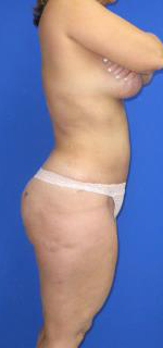 Liposuction Before & After Patient #580