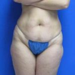 Avelar Tummy Tuck Before & After Patient #561