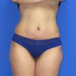 Avelar Tummy Tuck Before & After Patient #561