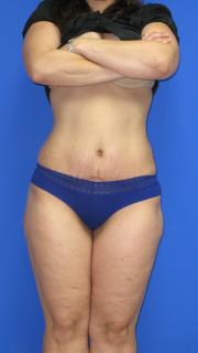 Avelar Tummy Tuck Before & After Patient #561
