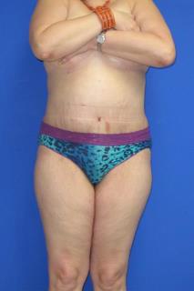 Avelar Tummy Tuck Before & After Patient #588