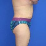 Avelar Tummy Tuck Before & After Patient #588