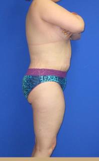 Avelar Tummy Tuck Before & After Patient #588