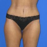 Avelar Tummy Tuck Before & After Patient #574