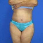 Avelar Tummy Tuck Before & After Patient #617