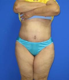 Avelar Tummy Tuck Before & After Patient #617