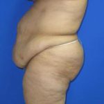 Avelar Tummy Tuck Before & After Patient #617