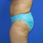 Avelar Tummy Tuck Before & After Patient #617