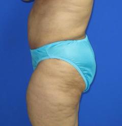 Avelar Tummy Tuck Before & After Patient #617