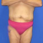 Fleur-de-Lis Tummy Tuck Before & After Patient #637