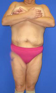Fleur-de-Lis Tummy Tuck Before & After Patient #637