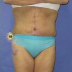 Fleur-de-Lis Tummy Tuck Before & After Patient #637