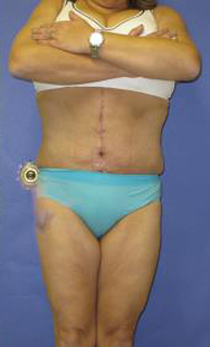 Fleur-de-Lis Tummy Tuck Before & After Patient #637