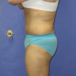 Fleur-de-Lis Tummy Tuck Before & After Patient #637