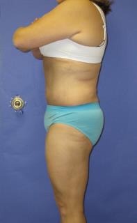 Fleur-de-Lis Tummy Tuck Before & After Patient #637