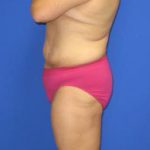 Fleur-de-Lis Tummy Tuck Before & After Patient #637