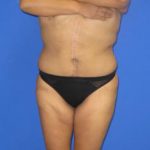 VASER Liposuction Before & After Patient #627