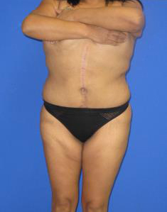 VASER Liposuction Before & After Patient #627