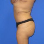 VASER Liposuction Before & After Patient #627