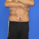 Fleur-de-Lis Tummy Tuck Before & After Patient #622