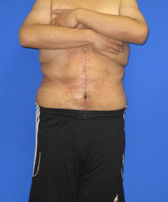 Fleur-de-Lis Tummy Tuck Before & After Patient #622