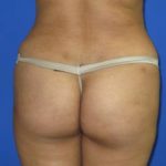 VASER Liposuction Before & After Patient #274