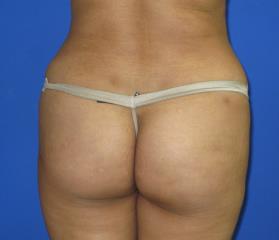 VASER Liposuction Before & After Patient #274