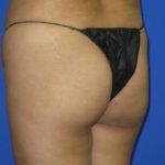 VASER Liposuction Before & After Patient #274