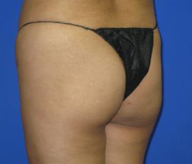 VASER Liposuction Before & After Patient #274