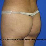 VASER Liposuction Before & After Patient #274