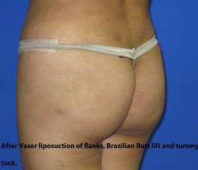 VASER Liposuction Before & After Patient #274