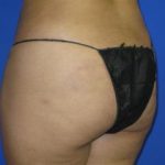 Liposuction Before & After Patient #291