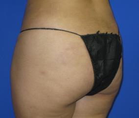 Liposuction Before & After Patient #291