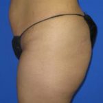 Liposuction Before & After Patient #291