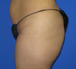 Liposuction Before & After Patient #291