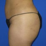 Liposuction Before & After Patient #291