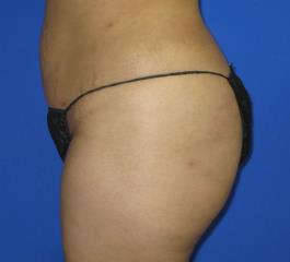 Liposuction Before & After Patient #291