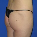 Brazilian Butt Lift Before & After Patient #280