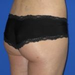 Brazilian Butt Lift Before & After Patient #280